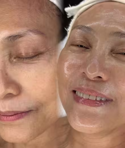 Piel sensible antes de Dermaplaning en Bogotá