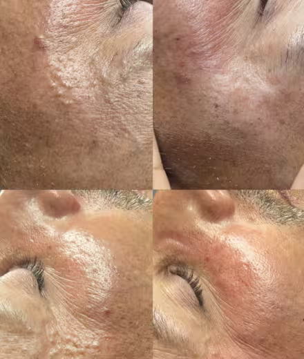 Antes de limpieza facial medicalizada en piel con acné activo