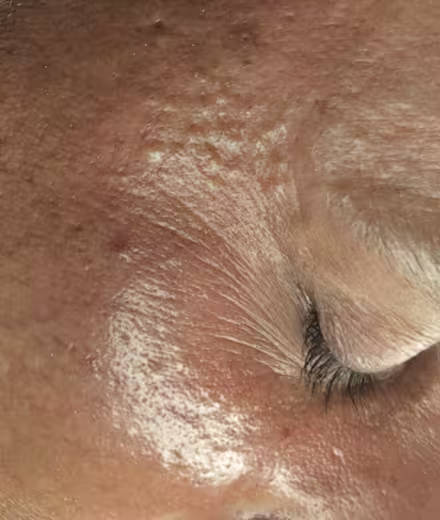 Después de limpieza facial – piel con menos grasa y más uniforme
