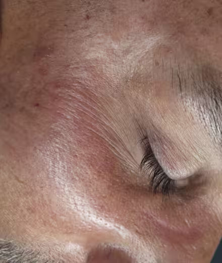 Resultado tras eliminación segura de quistes millium en el rostro