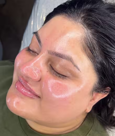 Resultado sin dermaplaning - Piel apagada