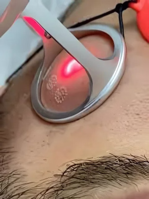 Láser CO2 iBlaze para melasma dérmico en Bogotá