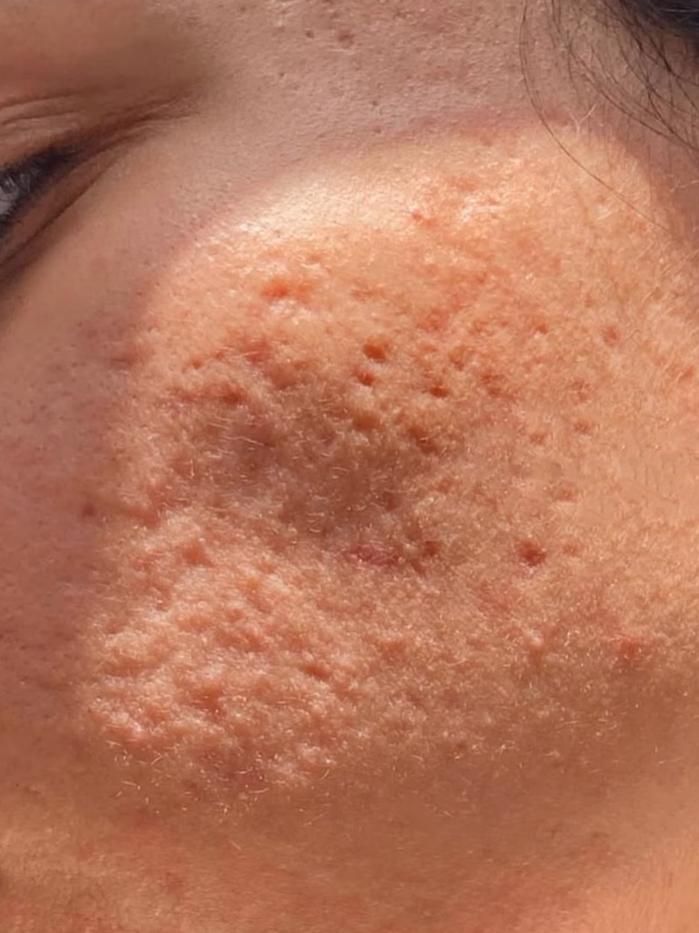 Limpieza facial medicalizada para acné en Bogotá